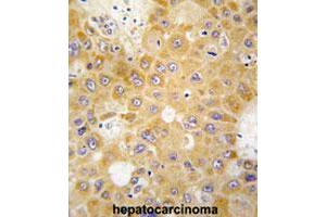 Formalin-fixed and paraffin-embedded human hepatocarcinomareacted with APH1A polyclonal antibody , which was peroxidase-conjugated to the secondary antibody, followed by AEC staining. (APH1A Antikörper  (N-Term))