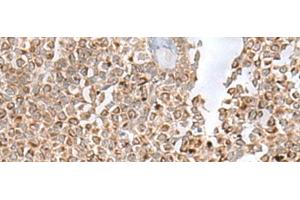 Immunohistochemistry of paraffin-embedded Human ovarian cancer tissue using GLYAT Polyclonal Antibody at dilution of 1:50(x200) (GLYAT Antikörper)