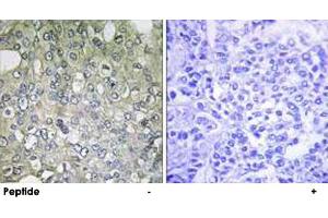 Immunohistochemistry analysis of paraffin-embedded human breast carcinoma tissue using ADRA1D polyclonal antibody . (ADRA1D Antikörper)