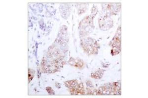 Immunohistochemical analysis of paraffin-embedded human breast carcinoma tissue using Raf-1 (Ab-259) antibody (E021006). (RAF1 Antikörper)