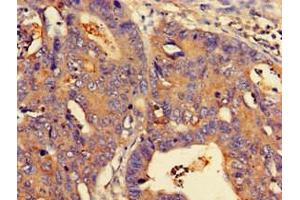 Immunohistochemistry of paraffin-embedded human colon cancer using ABIN7160778 at dilution of 1:100 (NMI Antikörper  (AA 62-202))