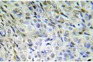 Immunohistochemistry (IHC) analyzes of p-beta-catenin (pSer33/pSer37/pThr41) antibody in paraffin-embedded human lung adenocarcinoma tissue. (CTNNB1 Antikörper  (pSer33, pSer37, pThr41))