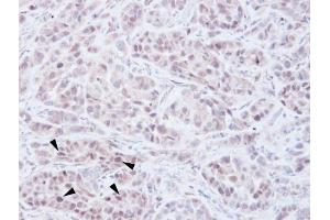 IHC-P Image Immunohistochemical analysis of paraffin-embedded A549 xenograft, using NSD2, antibody at 1:100 dilution.