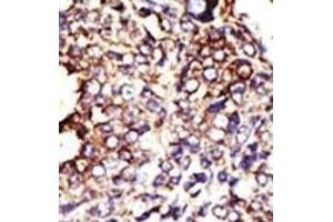 Formalin-fixed and paraffin-embedded human cancer tissue reacted with the primary antibody, which was peroxidase-conjugated to the secondary antibody, followed by DAB staining. (GCNT1 Antikörper  (AA 88-117))