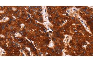 Immunohistochemistry of paraffin-embedded Human liver cancer using GPR124 Polyclonal Antibody at dilution of 1:40 (GPR124 Antikörper)