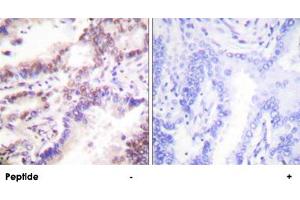 Immunohistochemistry analysis of paraffin-embedded human lung carcinoma tissue using RBBP8 polyclonal antibody . (Retinoblastoma Binding Protein 8 Antikörper)