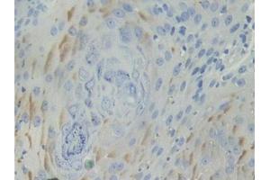 IHC-P analysis of Human Skin cancer Tissue, with DAB staining. (BCAM Antikörper  (AA 32-257))