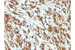 Formalin-fixed, paraffin-embedded human rhabdomyosarcoma stained with pan Muscle Actin antibody (MSA/953) (Pan Muscle Actin Antikörper)