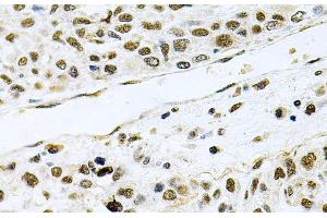 Immunohistochemistry of paraffin-embedded Human lung cancer using MCL1 Polyclonal Antibody at dilution of 1:100 (40x lens). (MCL-1 Antikörper)