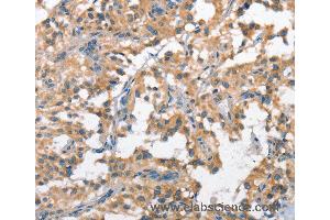 Immunohistochemistry of Human cervical cancer using SCARB1 Polyclonal Antibody at dilution of 1:60 (SCARB1 Antikörper)