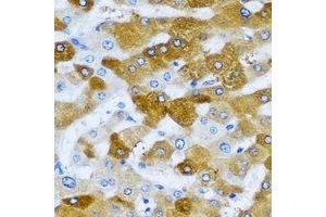 Immunohistochemical analysis of HAGH staining in human liver cancer formalin fixed paraffin embedded tissue section. (HAGH Antikörper)
