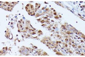 Immunohistochemistry of paraffin-embedded Human thyroid cancer using KIAA1429 Polyclonal Antibody at dilution of 1:100 (40x lens). (VIRMA/KIAA1429 Antikörper)