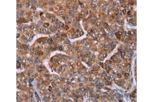 Immunohistochemistry of Human gastric cancer using HSPE1 Polyclonal Antibody at dilution of 1:40 (HSPE1 Antikörper)