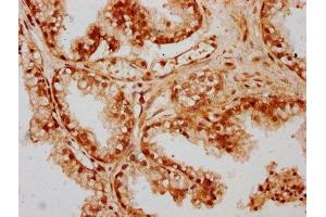 IHC image of ABIN7147479 diluted at 1:300 and staining in paraffin-embedded human prostate cancer performed on a Leica BondTM system. (GLTPD1 Antikörper  (AA 1-214))