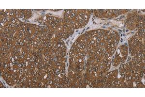 Immunohistochemistry of paraffin-embedded Human ovarian cancer tissue using FOLH1B Polyclonal Antibody at dilution 1:30 (FOLH1B Antikörper)