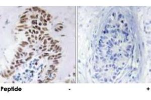 Immunohistochemical analysis of paraffin-embedded human lung carcinoma tissue using DAPK3 polyclonal antibody . (DAPK3 Antikörper)