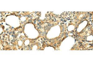Immunohistochemistry of paraffin-embedded Human thyroid cancer tissue using SERPINA12 Polyclonal Antibody at dilution 1:40