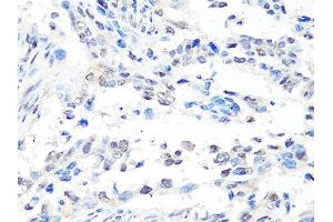 Immunohistochemistry of paraffin-embedded human lung cancer using MTA2 Antibody (ABIN4904441) at dilution of 1:100 (40x lens). (MTA2 Antikörper)