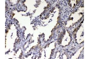 IHC testing of FFPE human lung cancer tissue with CCN3 antibody at 1ug/ml.