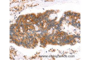 Immunohistochemistry of Human lung cancer using MLLT4 Polyclonal Antibody at dilution of 1:40