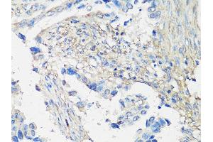 Immunohistochemistry of paraffin-embedded human lung cancer using MMP2 Antibody (ABIN5998246) at dilution of 1/100 (40x lens). (MMP2 Antikörper)