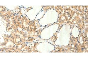 Immunohistochemistry of paraffin-embedded Human thyroid cancer using TRPM5 Polyclonal Antibody at dilution of 1:60 (TRPM5 Antikörper)