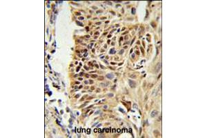 CIRBP Antibody IHC analysis in formalin fixed and paraffin embedded human lung carcinoma followed by peroxidase conjugation of the secondary antibody and DAB staining. (CIRBP Antikörper  (C-Term))