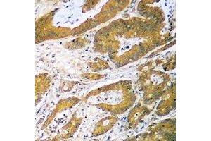 Immunohistochemical analysis of p53 staining in human colon cancer formalin fixed paraffin embedded tissue section.