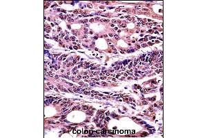 HMGB1 Antibody (C-term) (Ascites) (ABIN1536601)immunohistochemistry analysis in formalin fixed and paraffin embedded human colon carcinoma followed by peroxidase conjμgation of the secondary antibody and DAB staining. (HMGB1 Antikörper  (C-Term))