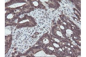 Immunohistochemical staining of paraffin-embedded Adenocarcinoma of Human colon tissue using anti-CBR3 mouse monoclonal antibody. (CBR3 Antikörper)