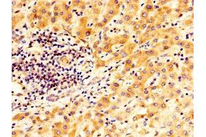 IHC image of ABIN7166409 diluted at 1:400 and staining in paraffin-embedded human liver cancer performed on a Leica BondTM system. (Transglutaminase 2 Antikörper  (AA 4-544))