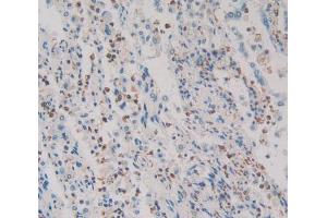 Used in DAB staining on fromalin fixed paraffin- embedded lung cancer tissue (HMGXB4 Antikörper  (AA 264-540))