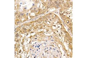 Immunohistochemistry of paraffin-embedded human lung cancer using UBB Rabbit pAb (ABIN6130181, ABIN6149775, ABIN6149776 and ABIN6222958) at dilution of 1:200 (40x lens). (UBASH3B Antikörper  (AA 1-300))