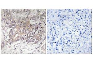 Immunohistochemistry analysis of paraffin-embedded human liver carcinoma tissue using GCNT3 antibody. (GCNT3 Antikörper  (Internal Region))