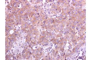 IHC-P Image TRAF5 antibody [N1N3] detects TRAF5 protein at cytoplasm on human breast carcinoma by immunohistochemical analysis. (TRAF5 Antikörper  (N-Term))