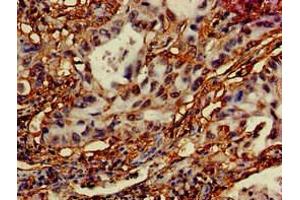 Immunohistochemistry of paraffin-embedded human lung cancer using ABIN7150140 at dilution of 1:100 (DRAM Antikörper  (AA 50-100))