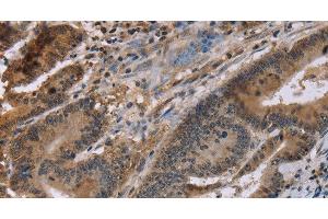 Immunohistochemistry of paraffin-embedded Human colon cancer tissue using FAM107A Polyclonal Antibody at dilution 1:30 (FAM107A Antikörper)