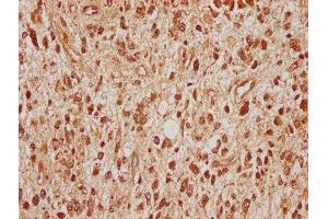 IHC image of ABIN7170677 diluted at 1:100 and staining in paraffin-embedded human glioma cancer performed on a Leica BondTM system. (SRPK2 Antikörper  (AA 471-688))