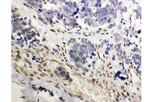 IHC-P: GR antibody testing of human lung cancer tissue (GR (AA 20-199) Antikörper)