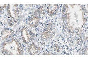 ABIN6276723 at 1/100 staining Human prostate tissue by IHC-P. (NAT1 Antikörper  (Internal Region))