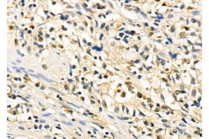 ABIN6260794 and ABIN6278439 at 1/100 staining Human colorectal cancer by IHC-P. (CHD1L Antikörper  (Internal Region))