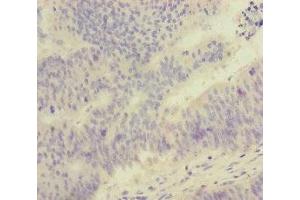 Immunohistochemistry of paraffin-embedded human colon cancer using ABIN7152525 at dilution of 1:100 (FOXRED1 Antikörper  (AA 307-486))