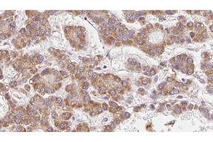 ABIN6273985 at 1/100 staining Human liver cancer tissue by IHC-P.