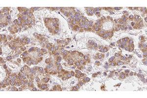 ABIN6273985 at 1/100 staining Human liver cancer tissue by IHC-P. (OR2V2 Antikörper  (Internal Region))