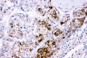 IHC-P: CBS antibody testing of human liver cancer tissue (CBS Antikörper  (AA 331-551))