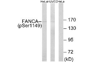 Immunohistochemistry analysis of paraffin-embedded human colon carcinoma tissue using FANCA (Phospho-Ser1149) antibody. (FANCA Antikörper  (pSer1149))