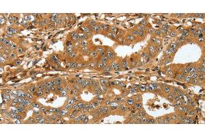 Immunohistochemistry of paraffin-embedded Human gastric cancer tissue using RAP1A Polyclonal Antibody at dilution 1:45 (RAP1A Antikörper)