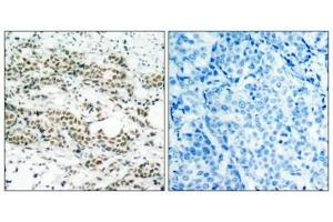 Immunohistochemical analysis of paraffin-embedded human breast carcinoma tissue using AFX(Phospho-Ser197) Antibody(left) or the same antibody preincubated with blocking peptide(right). (FOXO4 Antikörper  (pSer197))
