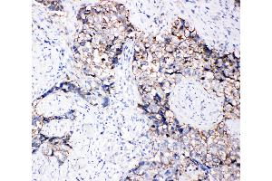 Anti-Eph receptor B3 antibody, IHC(P) IHC(P): Human Lung Cancer Tissue (EPH Receptor B3 Antikörper  (C-Term))