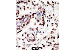 Formalin-fixed and paraffin-embedded human cancer tissue reacted with the primary antibody, which was peroxidase-conjugated to the secondary antibody, followed by AEC staining. (MLL/KMT2A Antikörper  (C-Term))